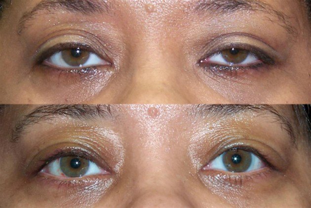 Age 45 — before and after ptosis repair
