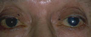 Note the pigmented lesion on the left upper eyelid
