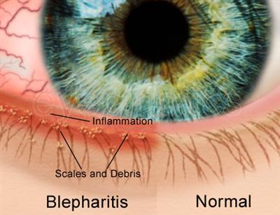 Blepharitis